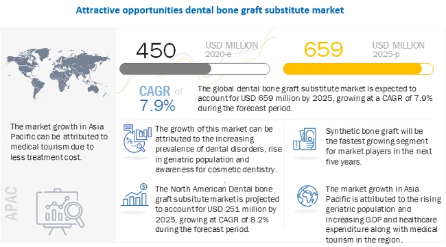 Dental Bone Graft Substitute Market to Reach USD 659 million by 2025 - Current and Future Perspectives